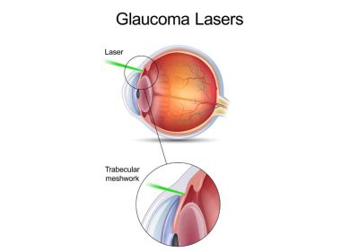 Types-of-laser-eye-surgery-for-glaucoma
