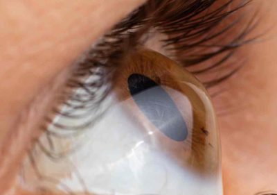 keratoconus treatment