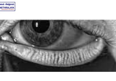 NORMAL MEIBOMIAN GLAND