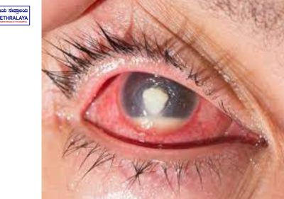 Corneal ulcers