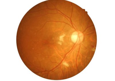 retina eye