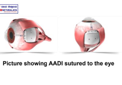 AADI