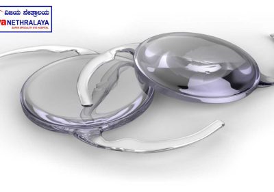 Cataract lens for eyes