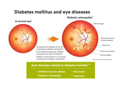 Diabetic Macular Edema