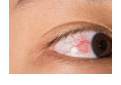 Episclera eye
