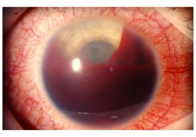Traumatic Hyphema Eye