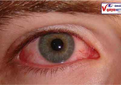pink eyes / Conjunctivitis