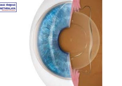 Implantable Contact Lens