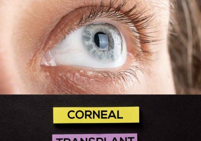 A women Corneal transplant eye