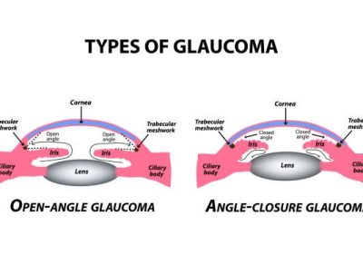 The two main types of glaucoma are Open-Angle and Angle-Closure.