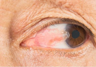 this image is shows that pterygium Eye treatment