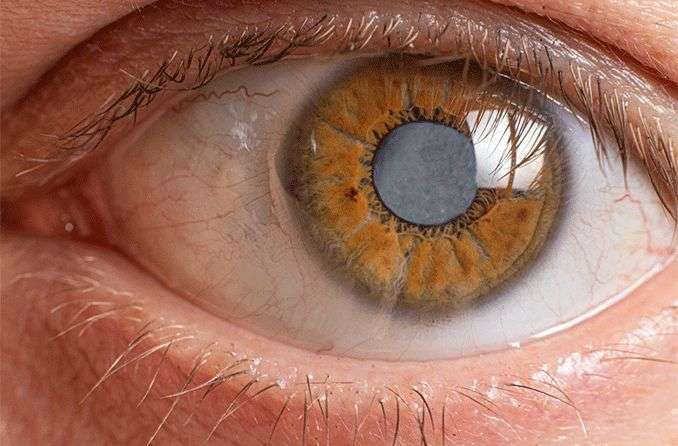 Cataract Eyes