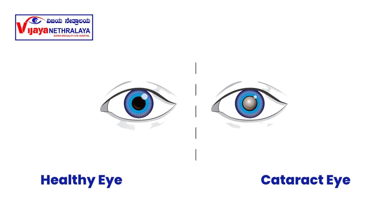Healthy Eye |& Cataract eye