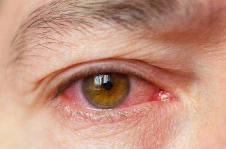 Eye redness one of the symptom of uveitis