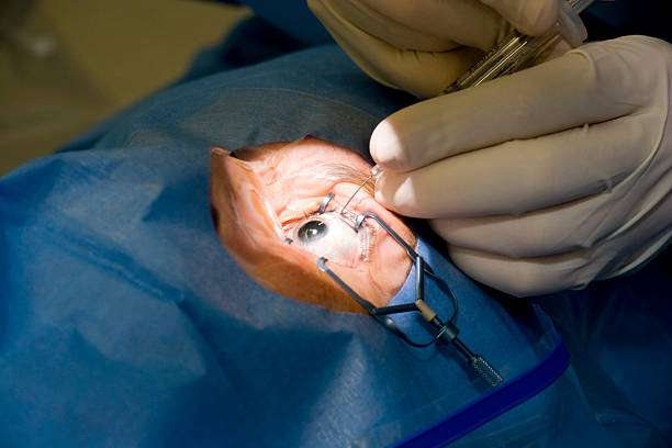 cornea transplant eye surgery
