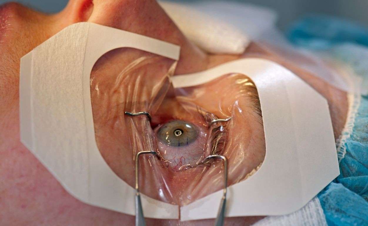 This is a picture of starting cornea transplant surgery