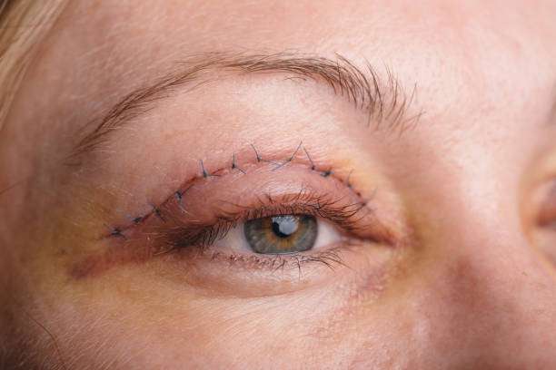 Blepharoplasty of the upper eyelid. An operation that removes