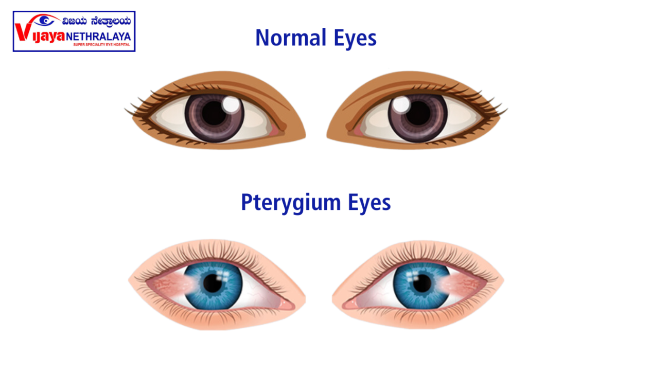 Normal Eyes v/s pterygium eyes