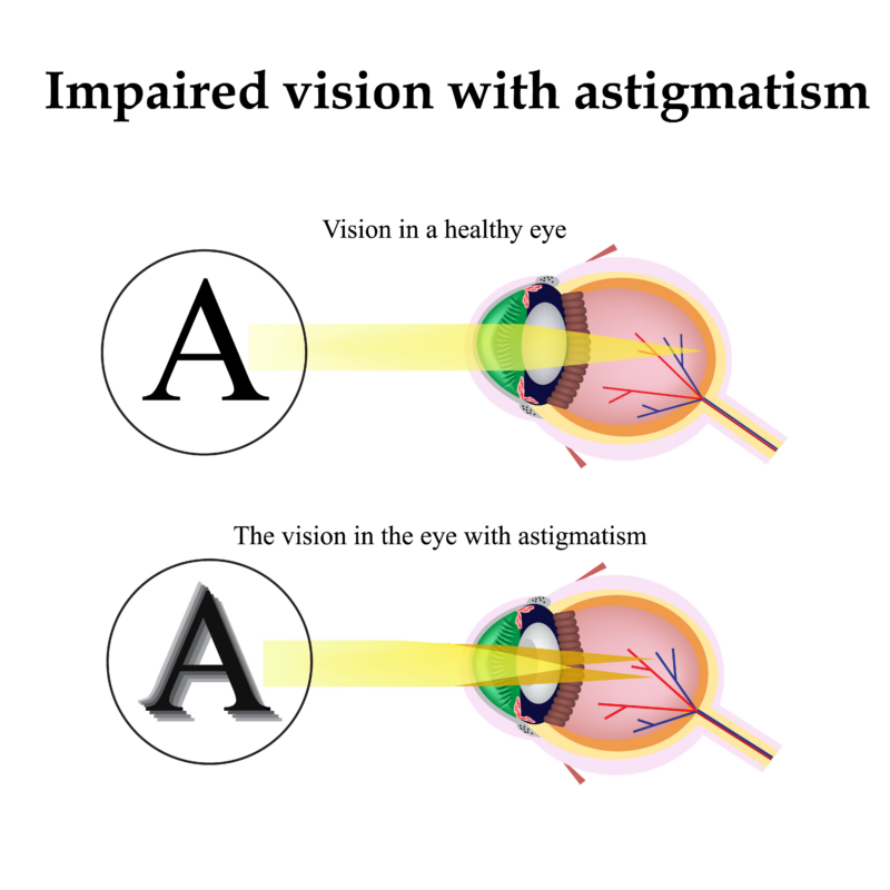 Eye Astigmatism