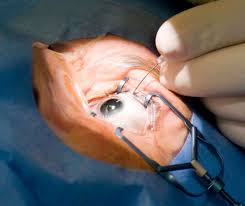 Retina Detachment Surgery