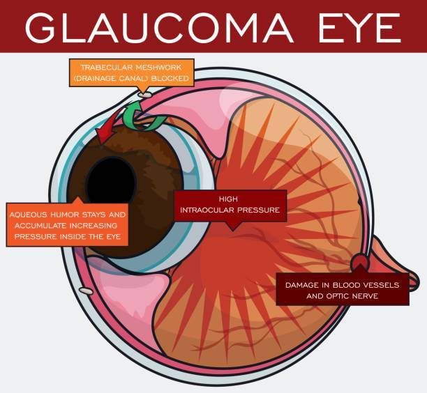 glaucoma eye