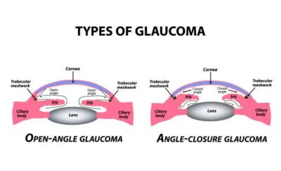 The two main types of glaucoma are Open-Angle and Angle-Closure.