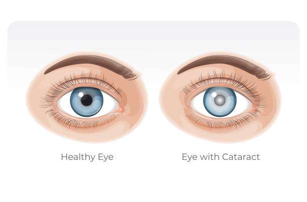 Human Healthy Eye and Eye with Cataract and how cataract affects your life