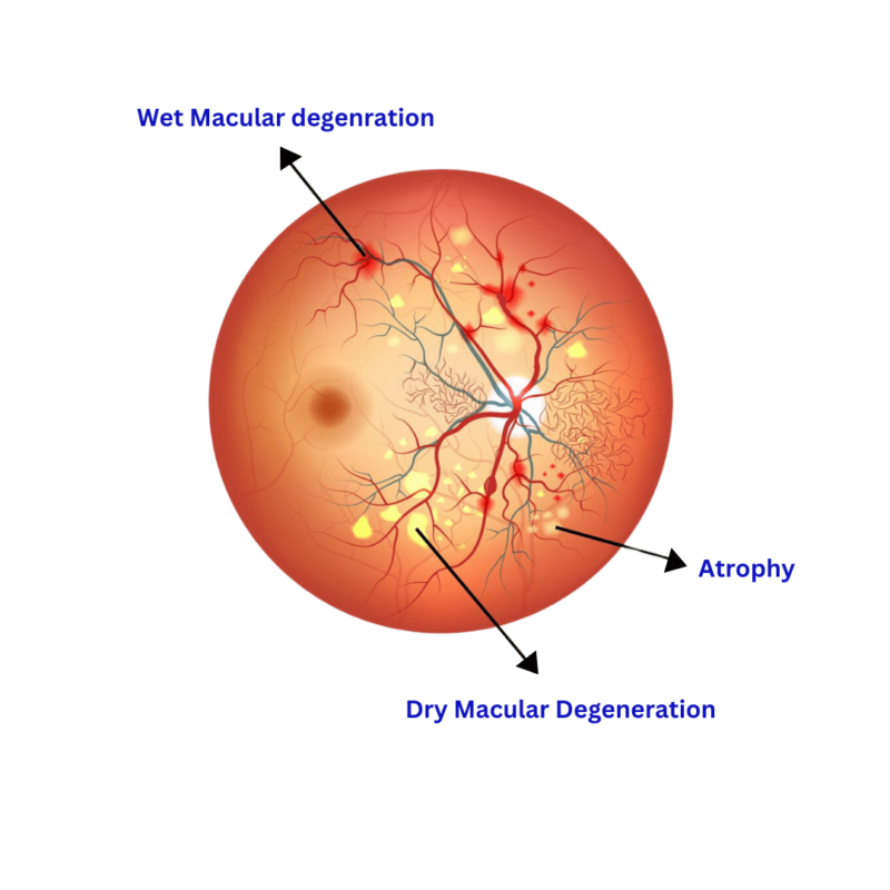 The picture showing the dry and wet macular degeneration stages and how it looks .