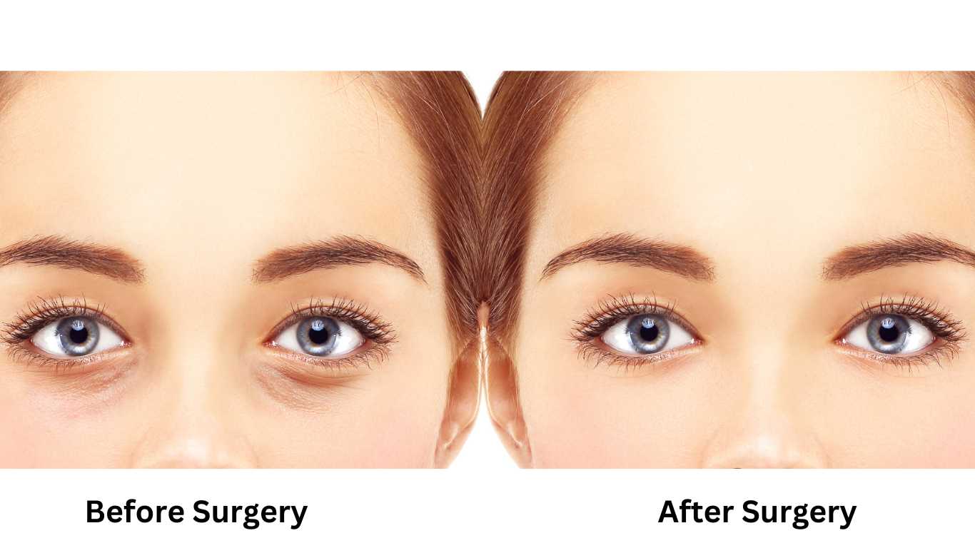 A Women Eyelid before and after surgery image