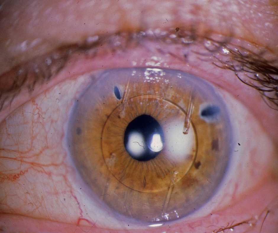 lower eye pressure after cataract surgery