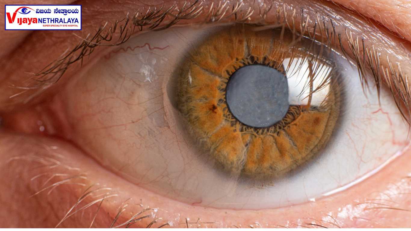 cataract eye of human