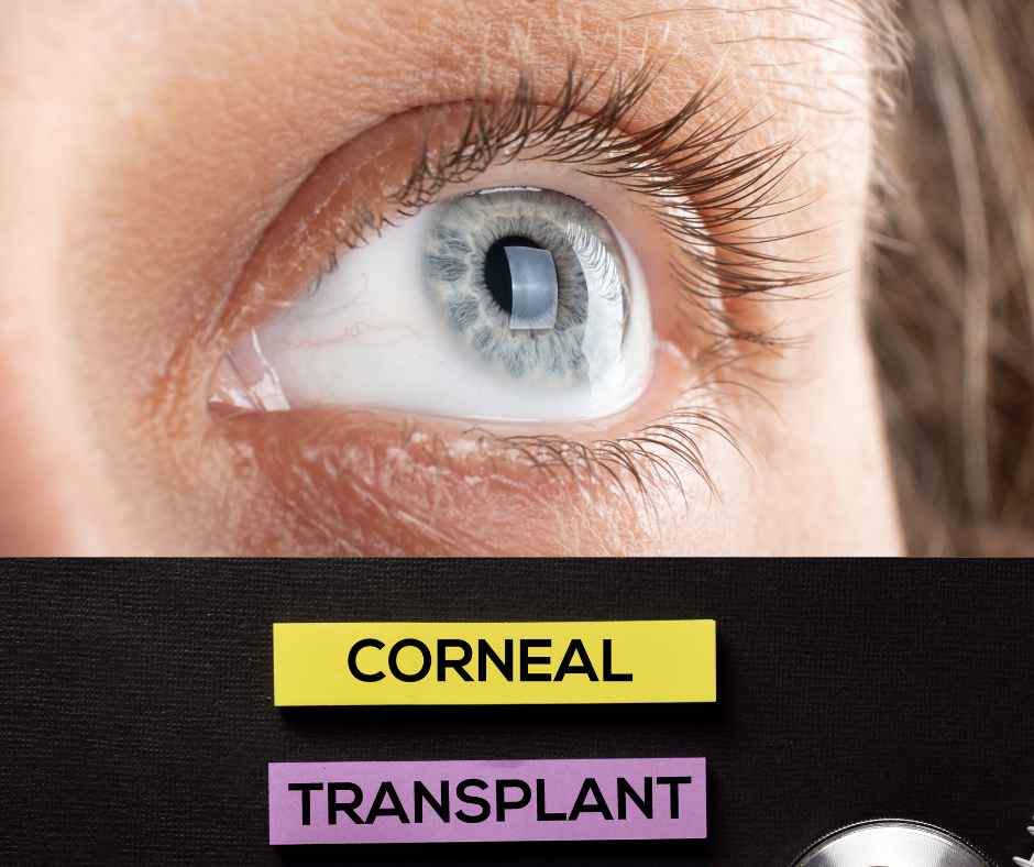 A women Corneal transplant eye