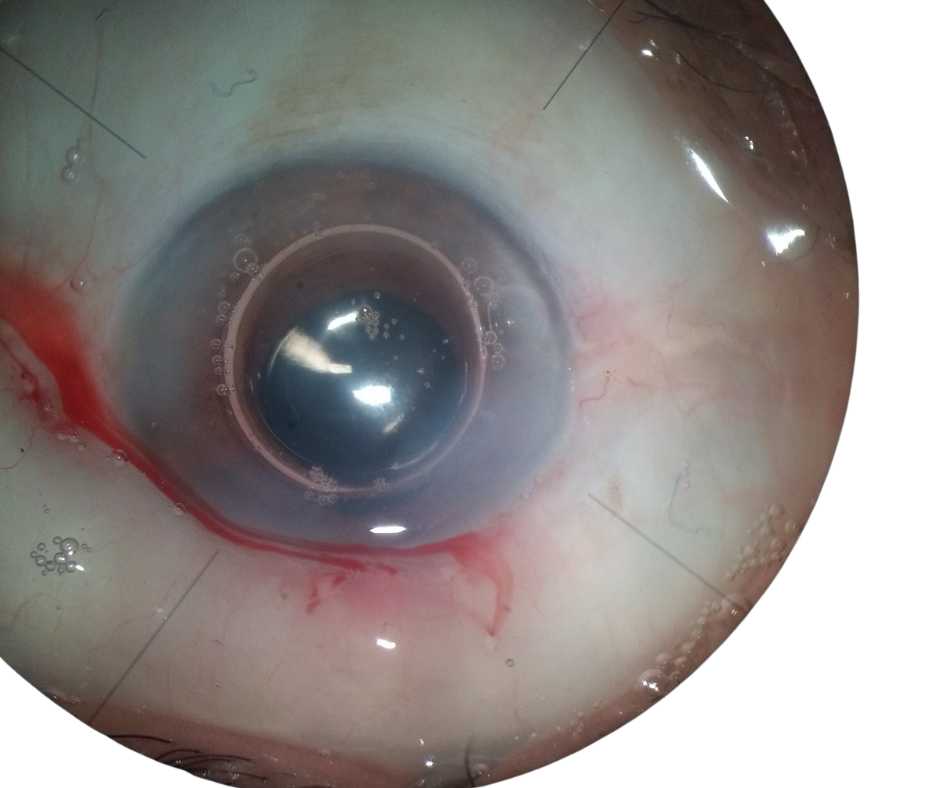 ELIMINATE CATARACTS WITHOUT SURGERY