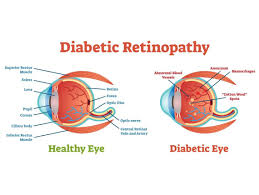 Diabetic retinopathy