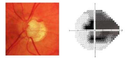 Optic disc cupping with corresponding visual field damage in glaucoma