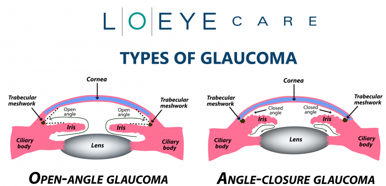 TYPES-OF-GLAUCOMA
