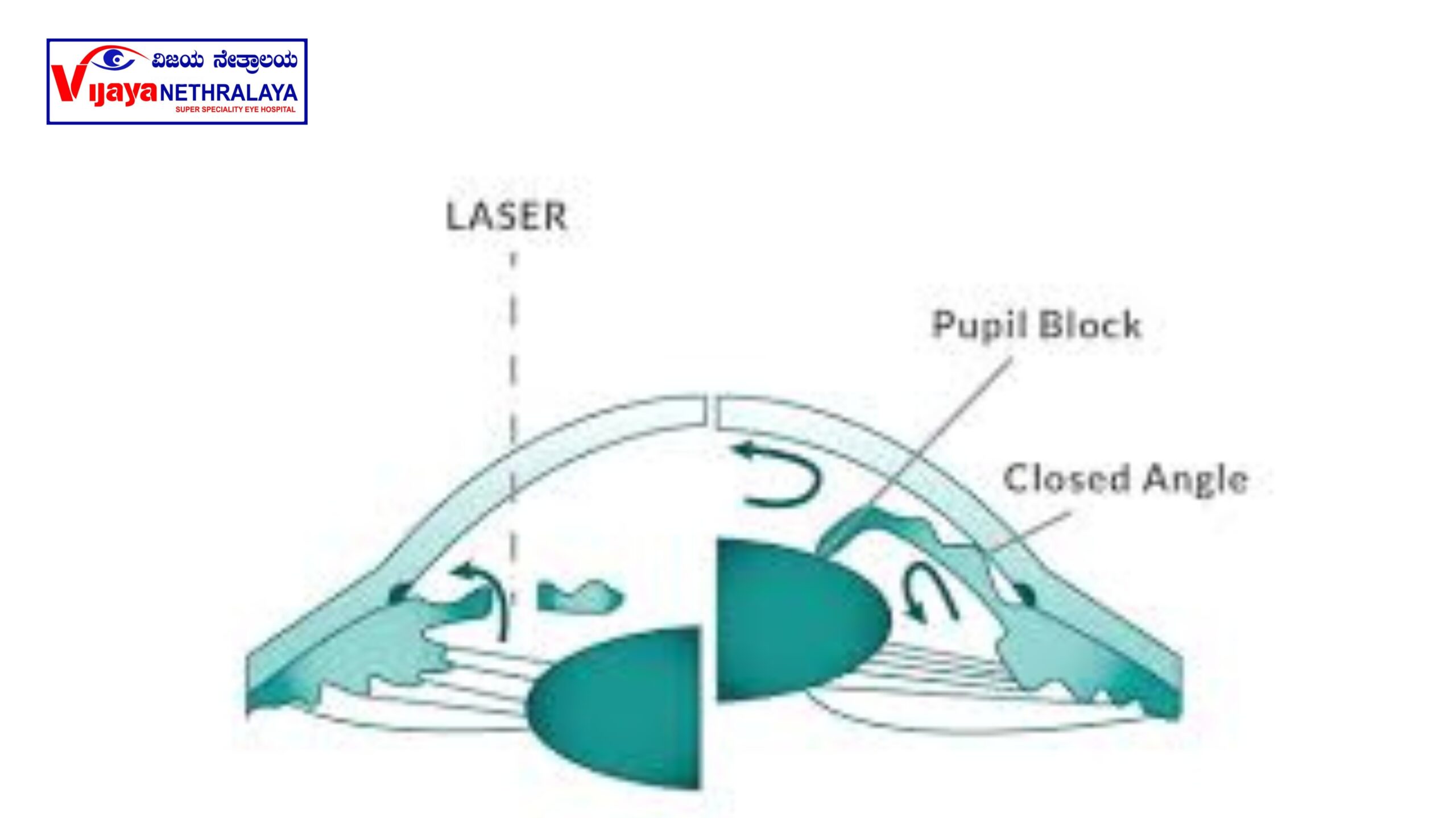 Laser Peripheral Iridotomy