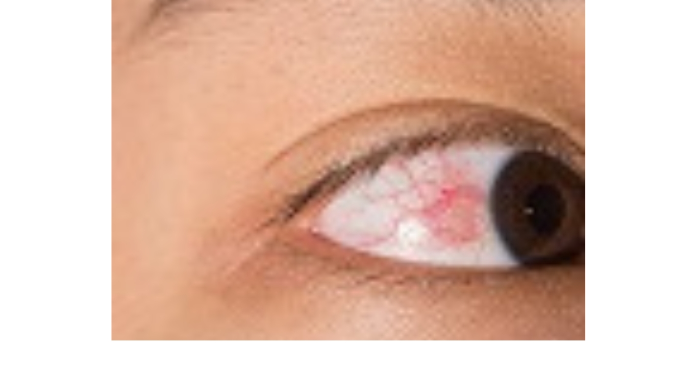 Episclera eye