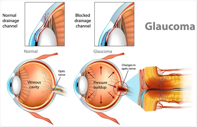 Types of congenital glaucoma