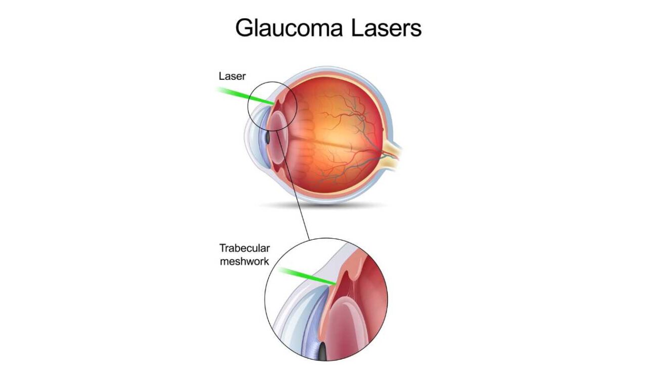Types-of-laser-eye-surgery-for-glaucoma