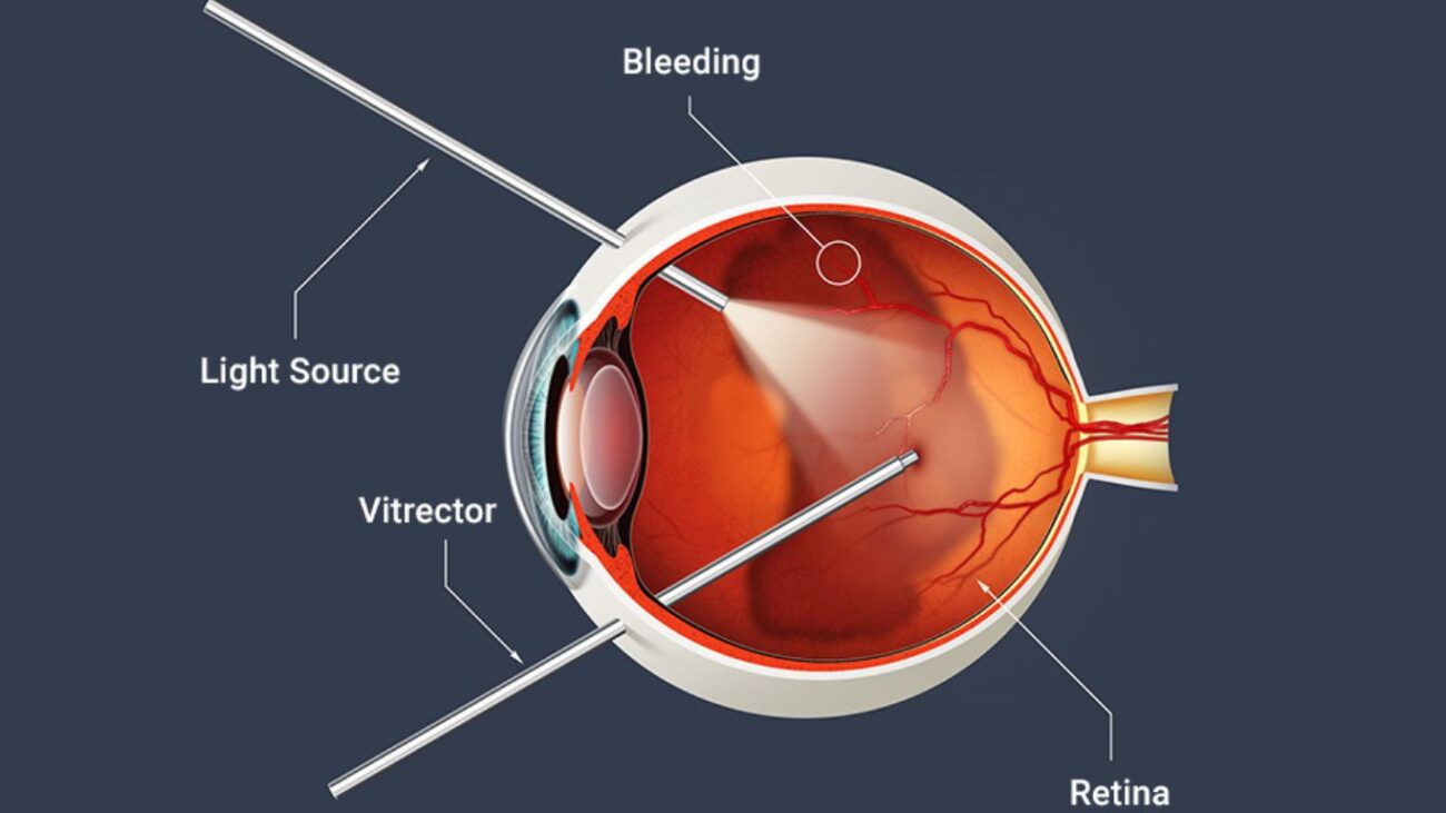 vitrectomy