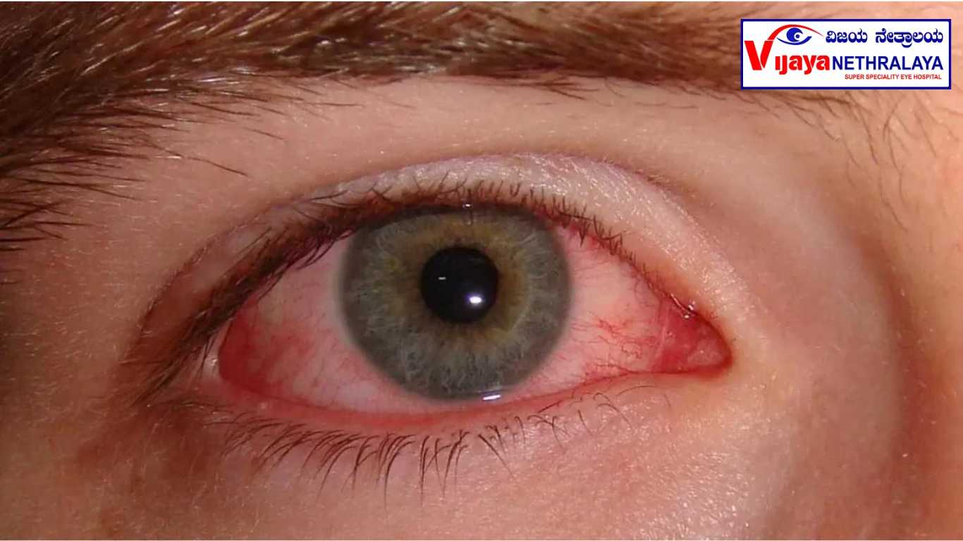 pink eyes / Conjunctivitis