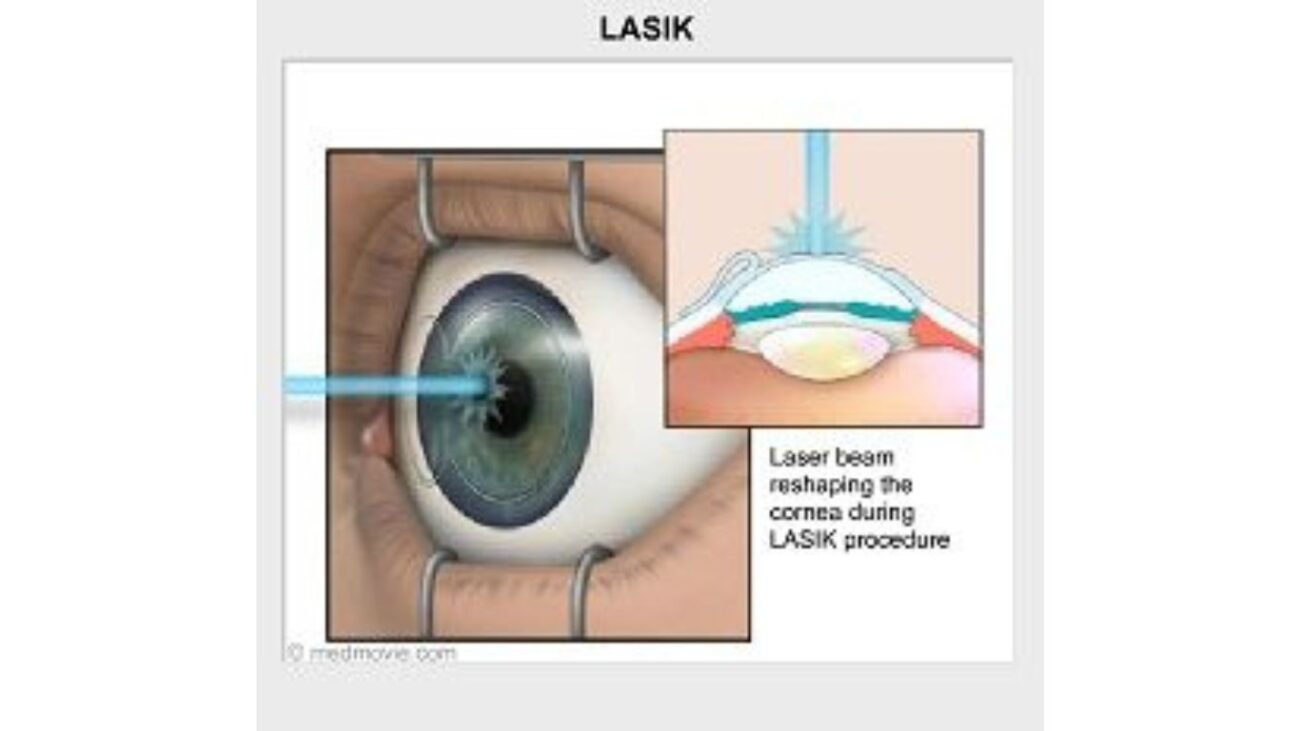 Lasik Eye