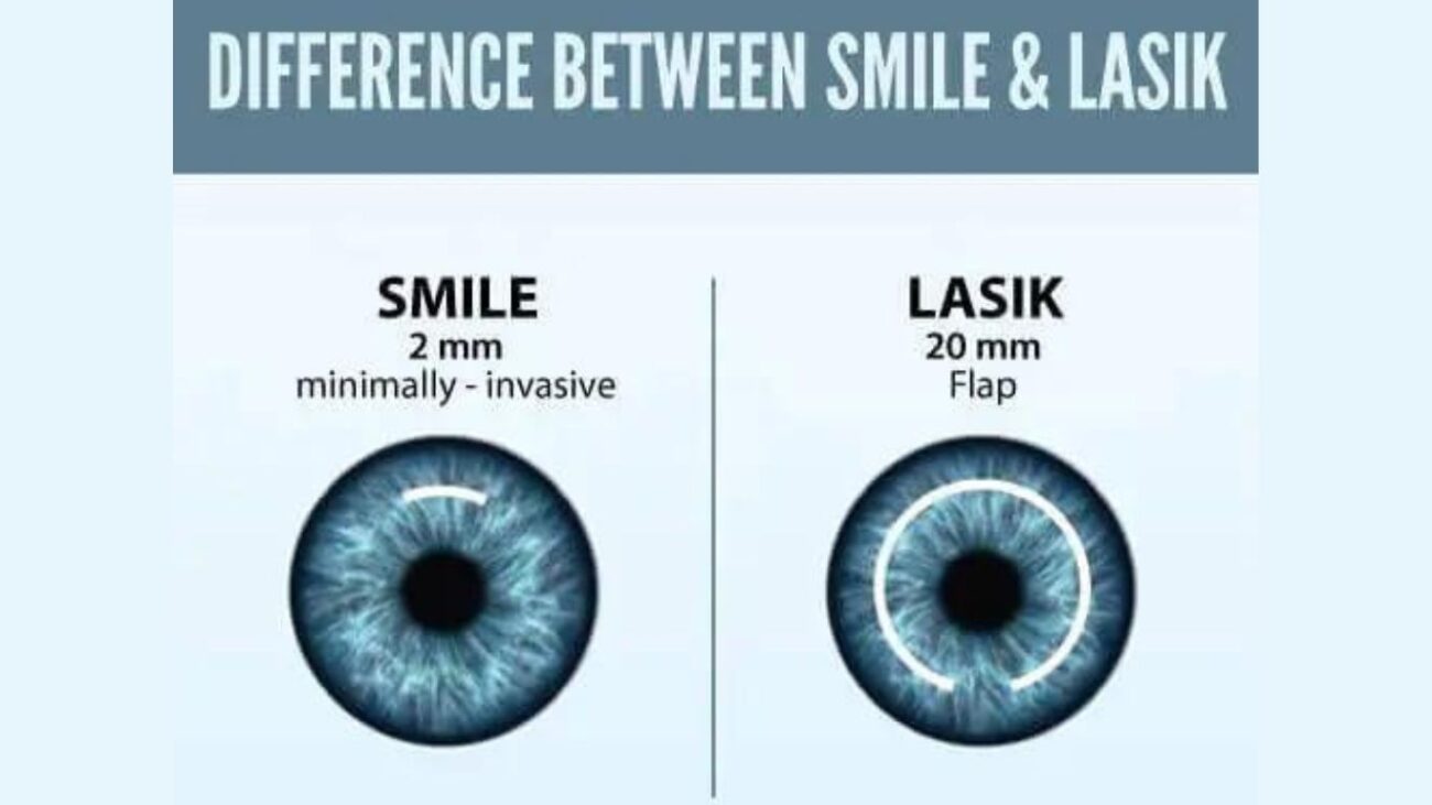 Smile lasik surgery
