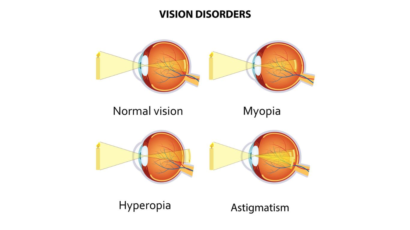Myopia and Hyperopia