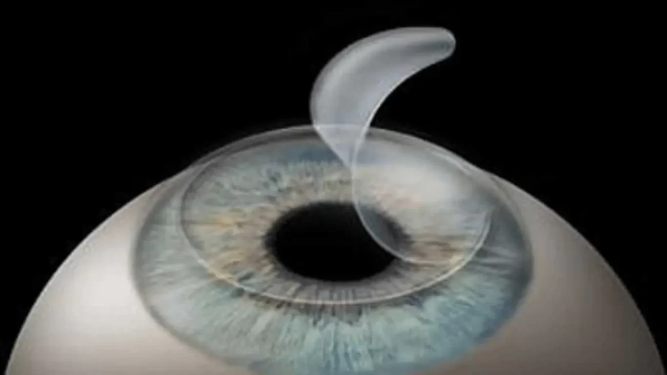 laser eye surgery