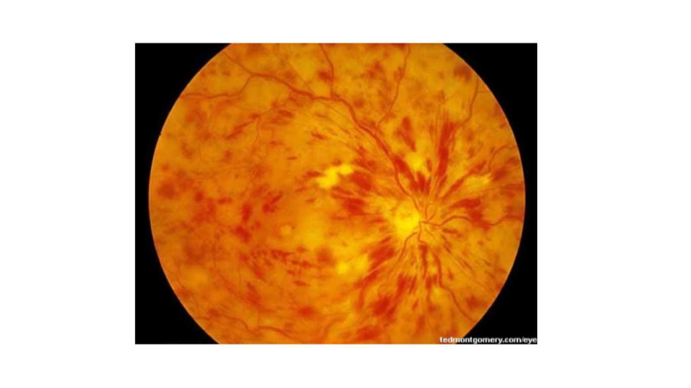 Central retinal vein occlusion