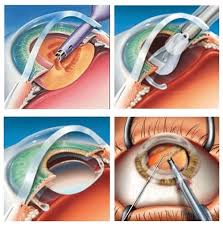 Cataract Surgery Process