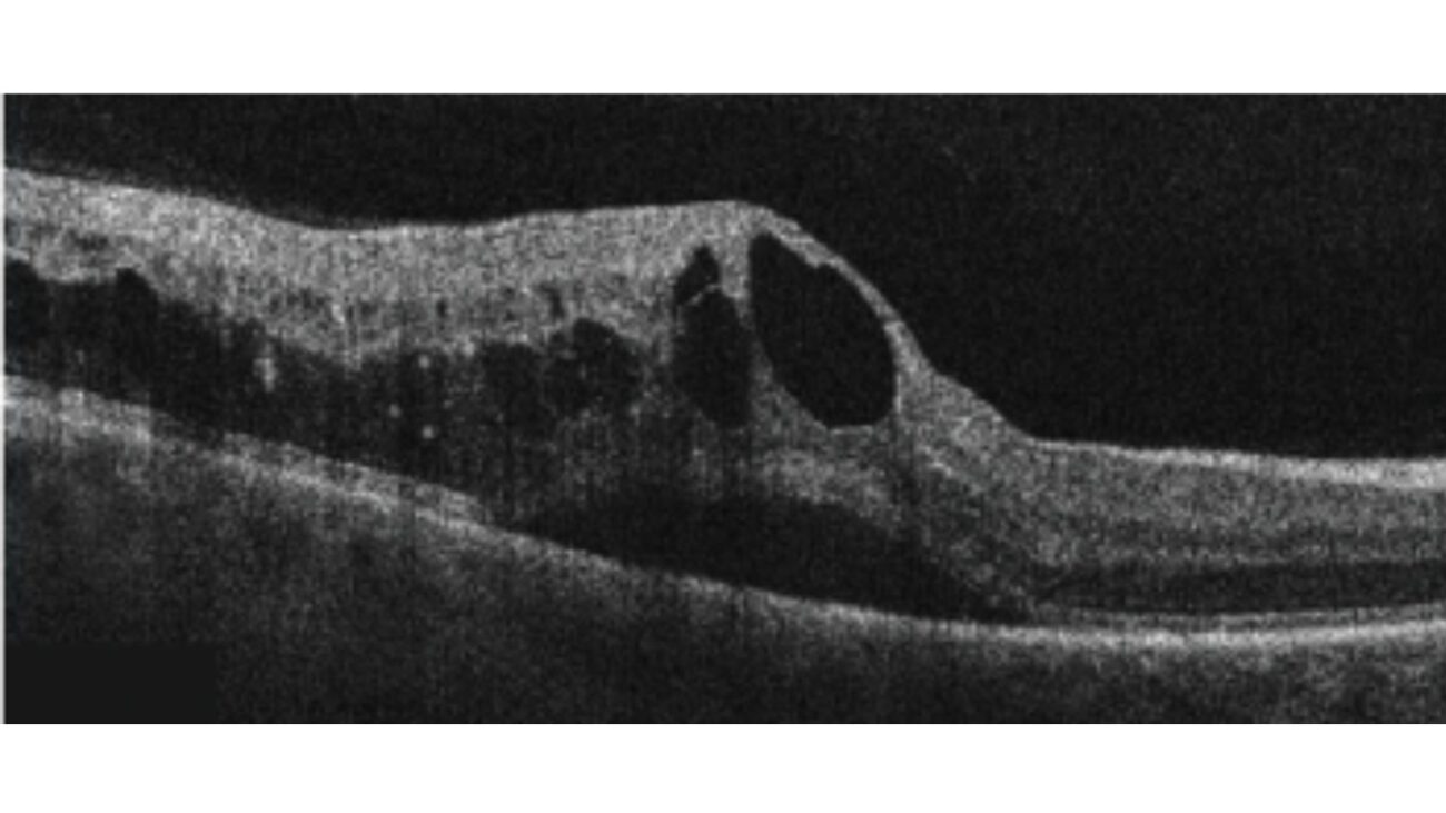 normal otc scan in retina