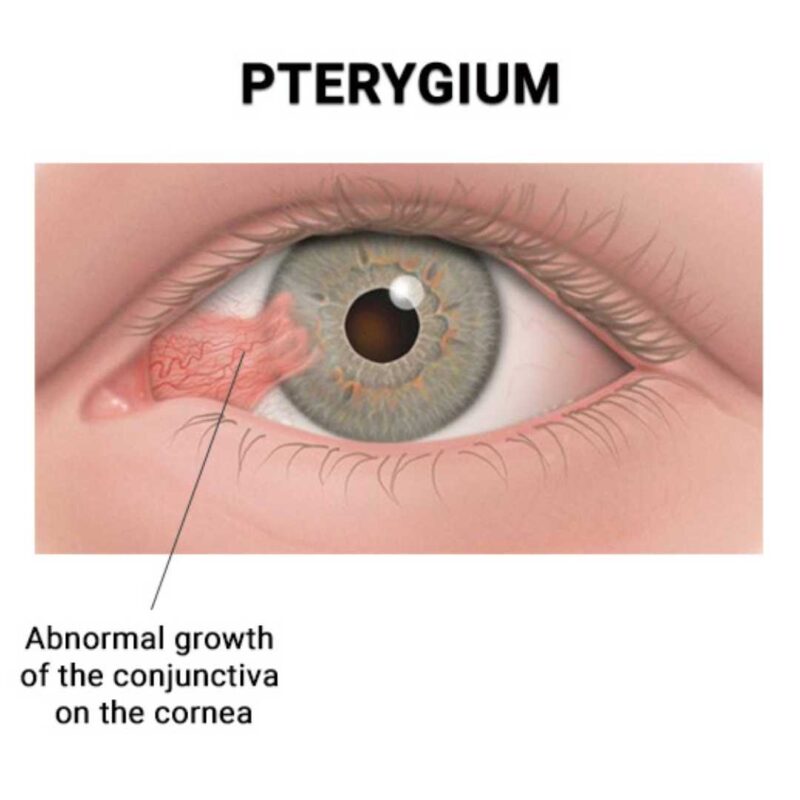 pterygium surgery cost